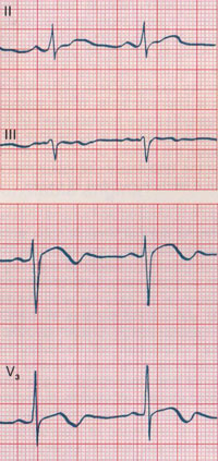 Long QT syndrome