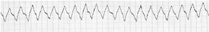 Monoporphic VT