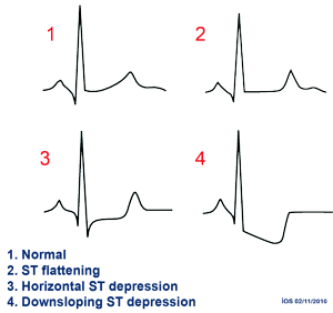 ST changes in Ischaemia
