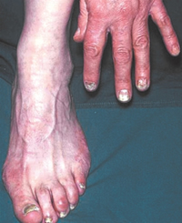 Onychomycosis