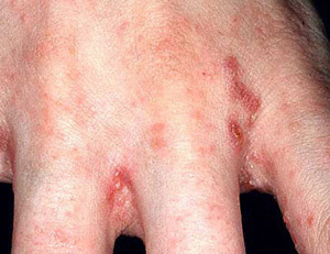 Scabies burrows often found in finger web spaces