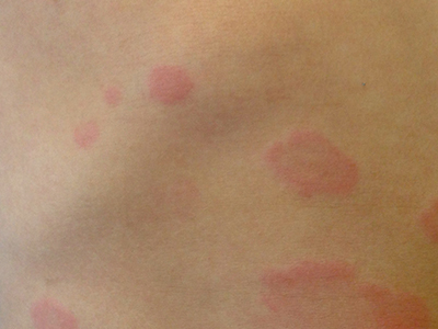 Urticarial rash