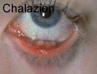 Chalazion Internal View