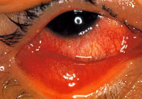 conjunctivitis