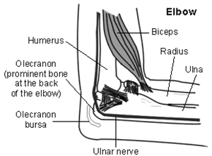 Olecranon bursitis