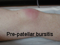 Pre-patellar bursitis