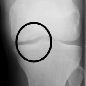 Knee Osteochondritis labelled