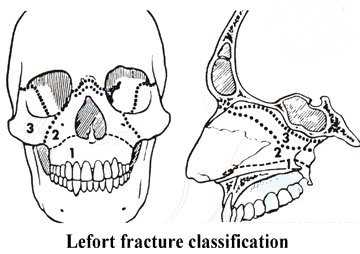 lefort fracture