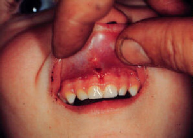 Upper lip frenulum laceration