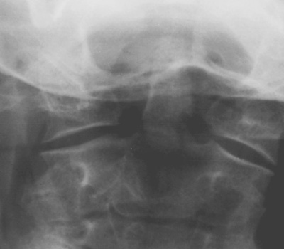 Odontoid Type 2