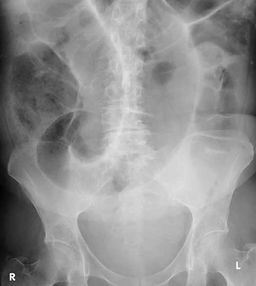 Volvulus