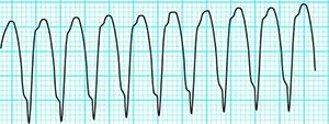 Monomorphic VT