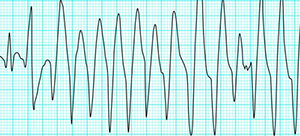 Polymorphic VT