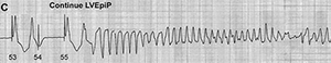 Torsade de Pointes