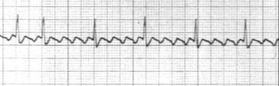 Atrial Flutter Valsalva