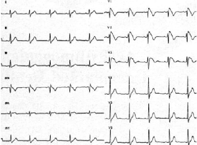 Brugada Syndrome