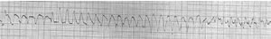 Polymorphic VT