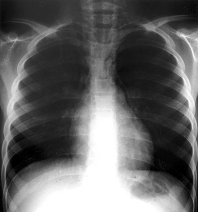 Pneumomediastinum. Note lucency between left heart border and mediastinum
