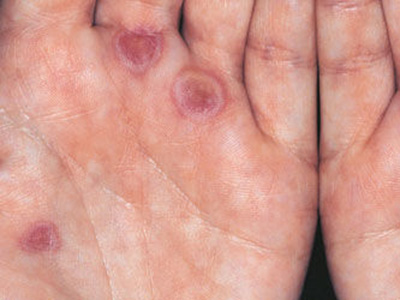 target lesions