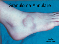 Granuloma Annulare