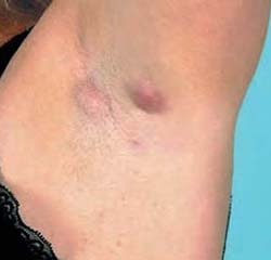 Hydradenitis, mild, early