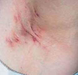 Hydradenitis moderate