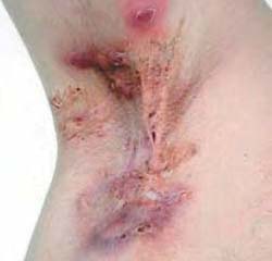 Hydradenitis late scarring