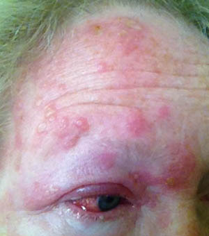 HZ Ophthalmicus