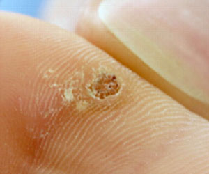 Plantar Wart