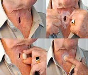 Laryngectomy