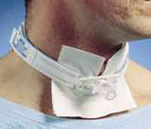 Tracheostomy