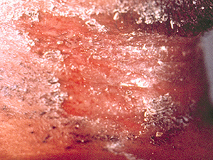 Cutaneous Diphtheria