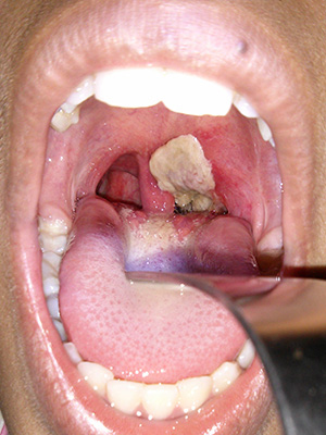 Diphtheria membrane