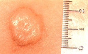 Positive mantoux at 48 hours