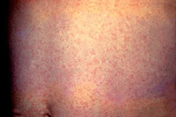 Rubella Rash (from Wikipedia)