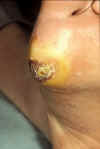 Diabetic Foot 1