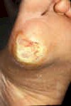Diabetic Foot 2