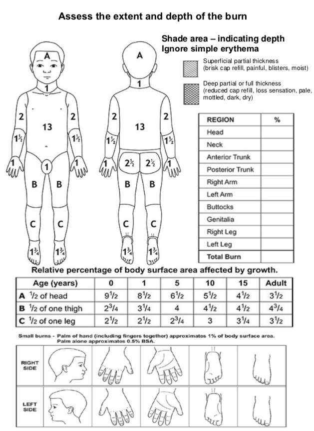 Lund and Browder chart for paediatric TBSA assessment