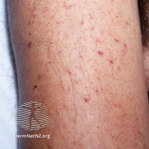 Petechiae