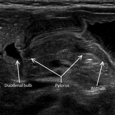 pyeloric stenosis