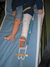 Thomas Splint in Situ