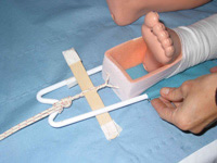 Using the taped Spalulae as a Windlass