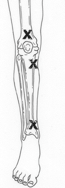 IO suggested sites leg
