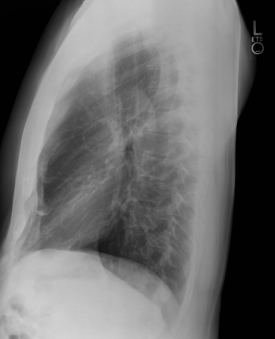 Lateral CXR