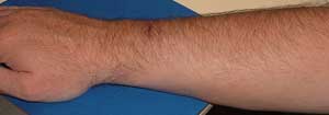 Location of Intersection Syndrome symptoms