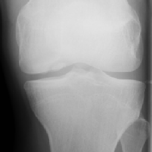 Knee Osteochondritis
