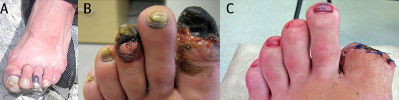 FrostBite Grdaes - Thank You BMJ Nov 2010