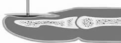 Finfer nail trephine lateral
