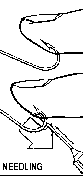 Removing fish hook by needling