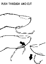Fish Hook Removal push through after removing eye